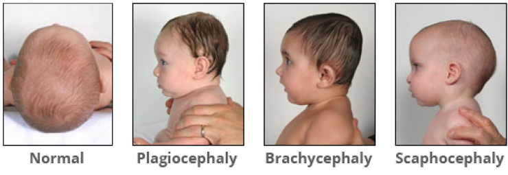 اسباب اختلاف و تغير شكل راس الطفل
