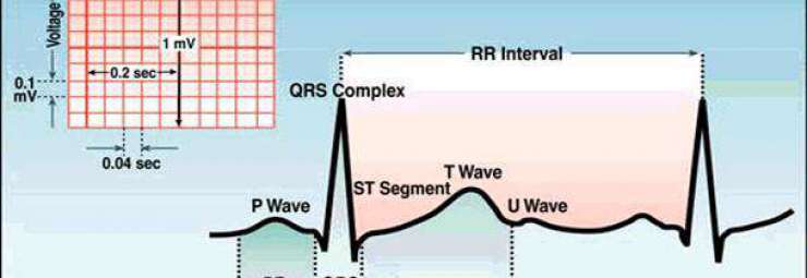 اضطراب نظم القلب عند الطفل - خلل ضربات القلب على ECG