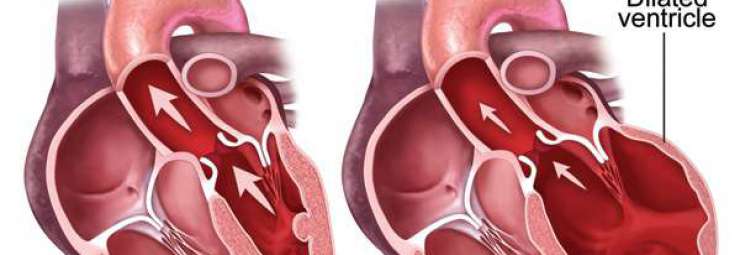 اعتلال العضلة القلبية التوسعي او التمددي عند الاطفال