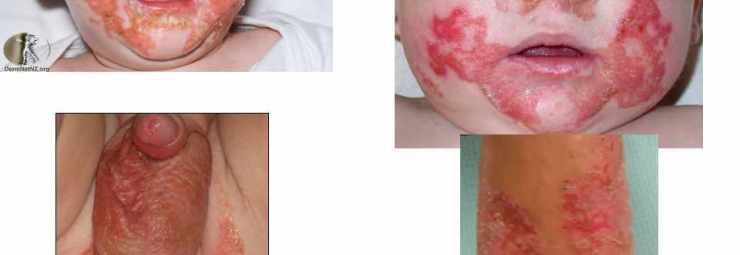 اعراض التهاب جلد الاطراف عند الاطفال و الرضع