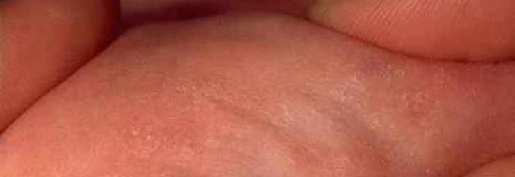 التصلب الدهني تحت الجلد الوليدي