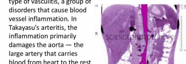 التهاب الشرايين تاكاياسو