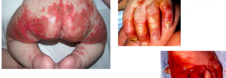 التهاب جلد الاطراف عند الاطفال و الرضع
