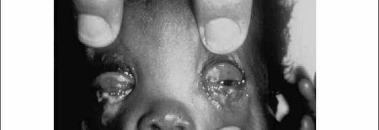 التهاب عين الطفل المولود ببكتيريا البنيات