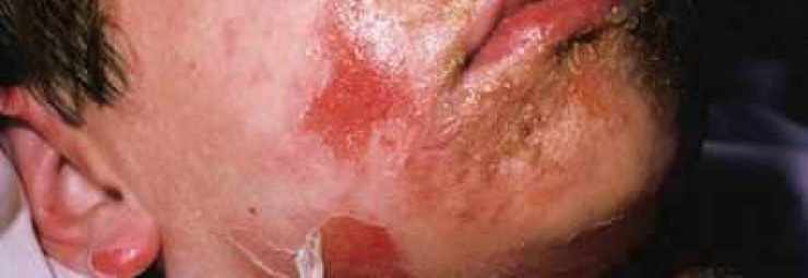تشخيص و معالجة متلازمة الجلد المسموط بالعنقوديات