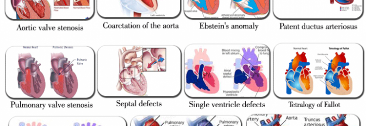 تشوه القلب عند الأطفال