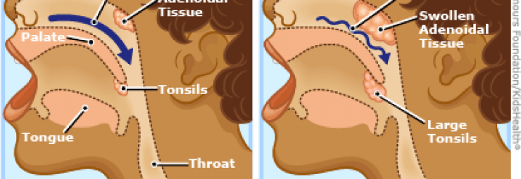 توقف تنفس الطفل و الرضيع و هو نائم