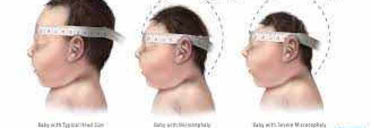 جدول حجم رأس الطفل الطبيعي حسب العمر