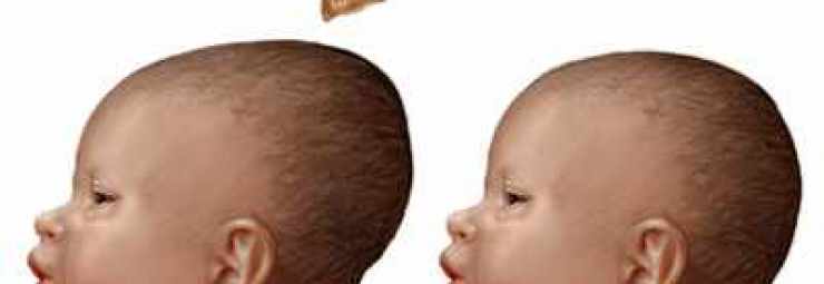 رأس الطفل حديث الولادة