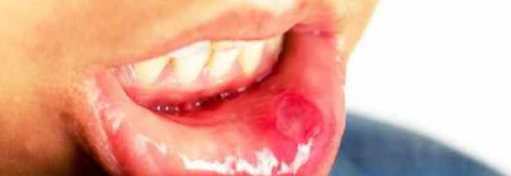 علاج التهاب الفم القلاعي
