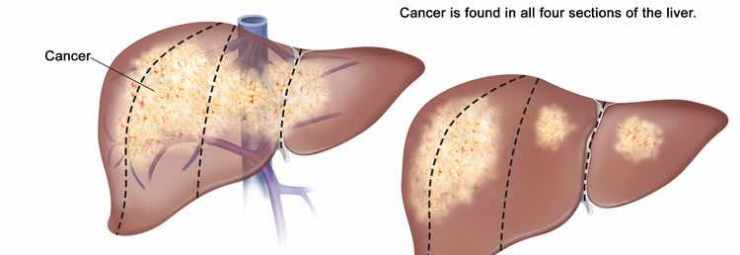 كارسينوما الكبد عند الاطفال