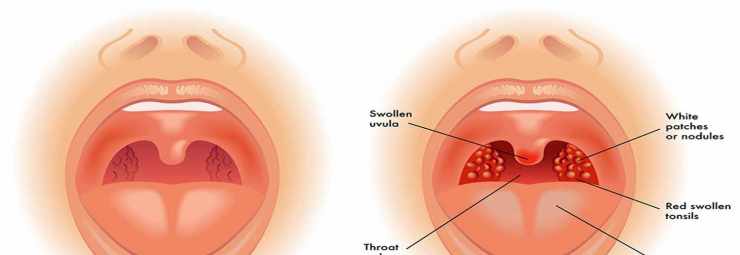 ما علاج التهاب اللوز عند الاطفال