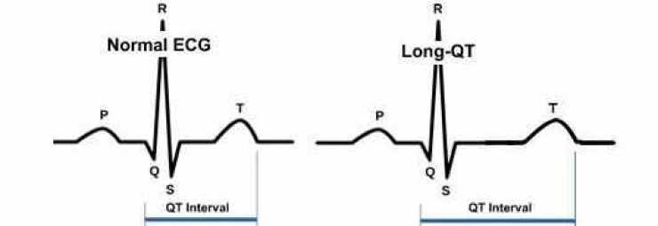 متلازمة QT الطويلة