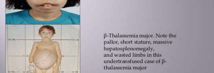 مرض الثلاسيميا