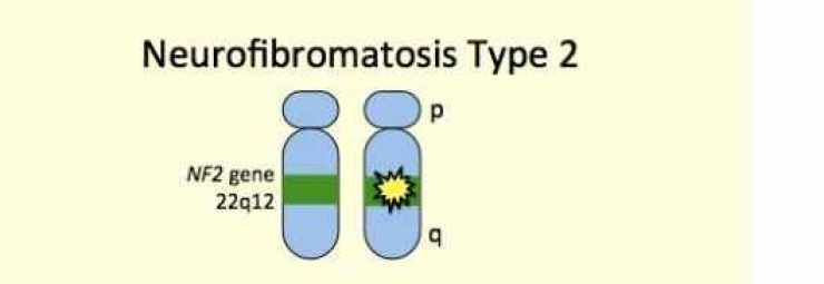 مرض الورام الليفي العصبي-النمط الثاني
