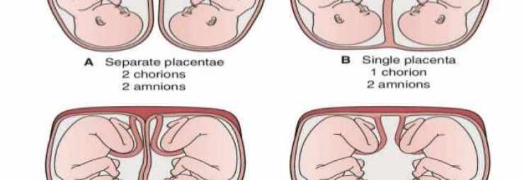 مشاكل الحمل التوأم
