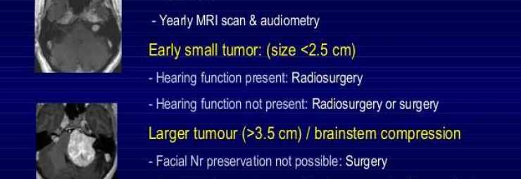 مشاكل ما بعد علاج ورم العصب السمعي