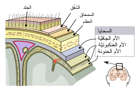 التهاب السحايا