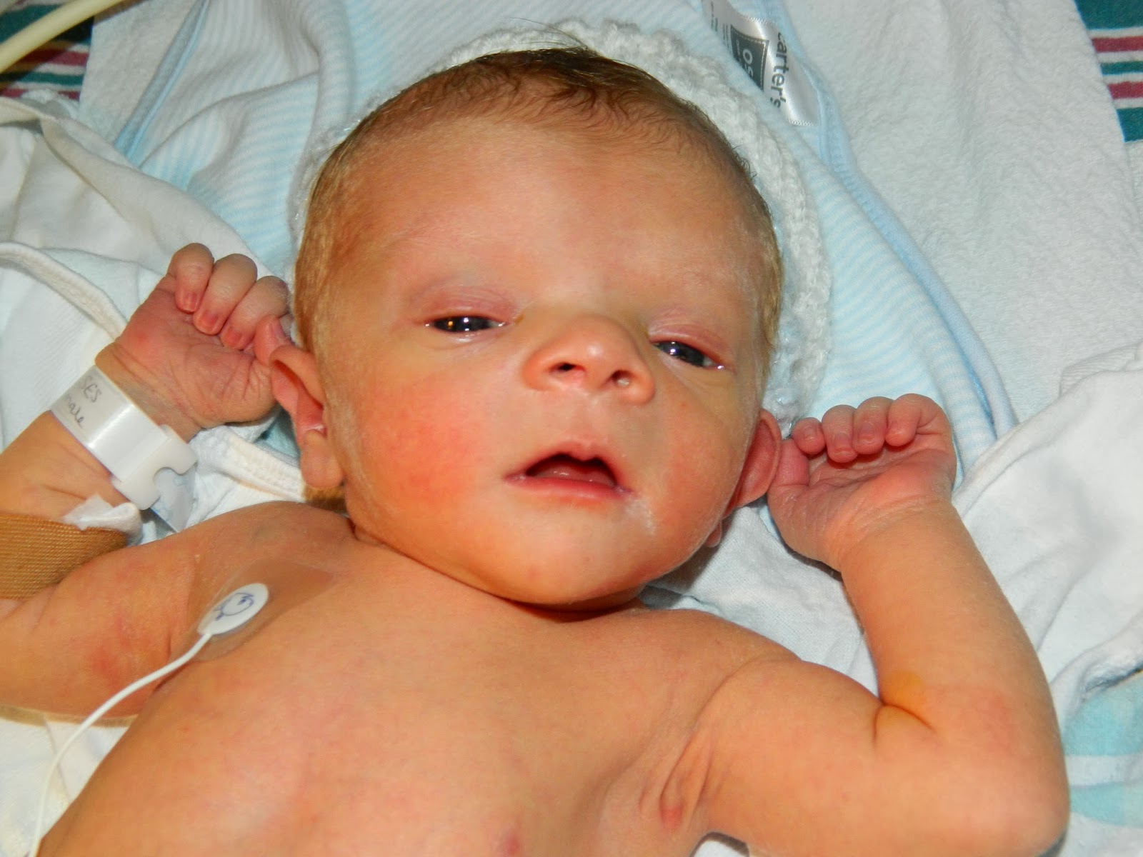 طفل مصاب بمتلازمة نونان