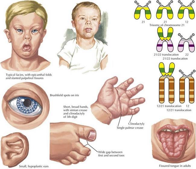 علامات متلازمة داون بالصور