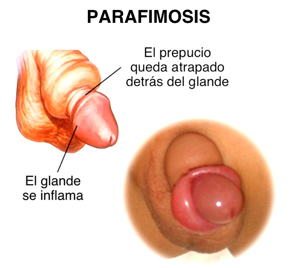 paraphimosis